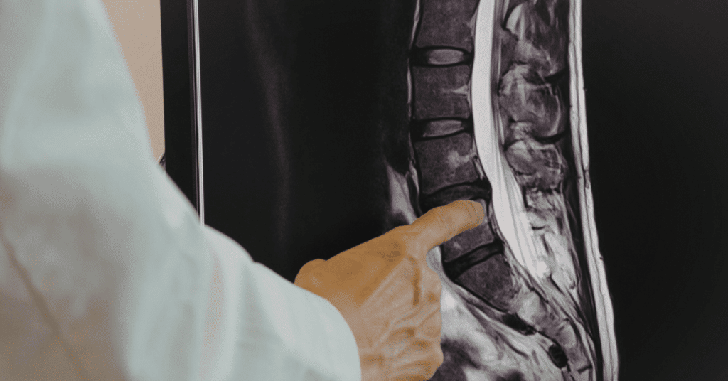 Doctor looking at a spinal cord injury x-ray
